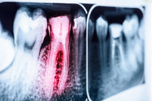 Root Canals at Olentangy Modern Dental