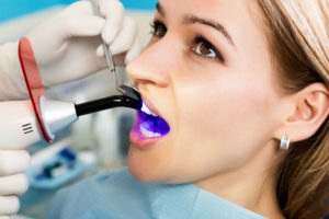 Dental Bonding in progress
